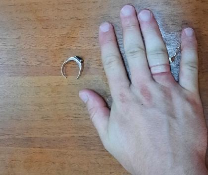 В Кунгуре спасатели помогли молодому человеку снять с распухшего пальца кольцо